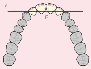 Figure 11.4. a) Cl I: The diametric fulcrum axis passing through the terminal abutments 12 and 22.