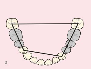 Figure 11.50. a) Cl III Mod 1: Quadrangular support plane between terminal abutments 44, 47, 33, and 37