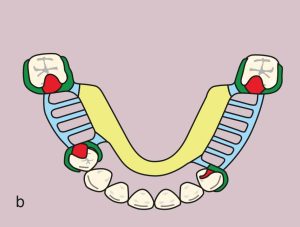Figure 11.50. b) Metal framework design