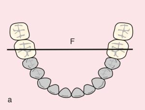 Figure 11.53. a) Cl IV: Diametric fulcrum axis passing through terminal abutments 36 and 46.