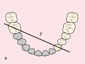 Figure 11.54. a) Cl IV: Diagonal fulcrum axis passing through terminal abutments 33 and 46.