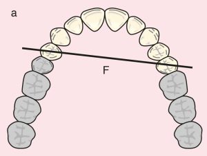 Figure 11.5. a) Cl I: The diagonal fulcrum axis passing through the terminal abutments 14 and 25.