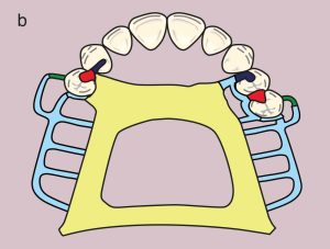 b) Metal framework design.