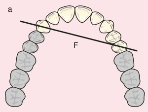 Figure 11.6. a) Cl I: The diagonal fulcrum axis passing through the terminal abutments 13 and 25.