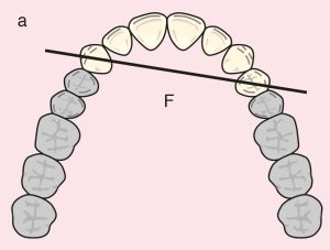 Figure 11.7. a) Cl I: The diagonal fulcrum axis passing through the terminal abutments 13 and 24.