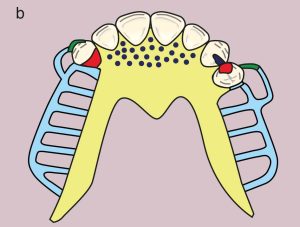 Figure 11.7. b) Metal framework design.