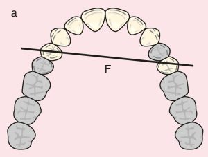 Figure 11.8. a) Cl I Mod 1: The diagonal fulcrum axis passing through the terminal abutments 14 and 25.