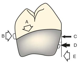 Figure 3-12. When the prosthesis is in the resting position, the clasp components should remain passive on the abutment tooth. (A) Height of contour, (B) Stabilization arm, (C) Cervical inclination angle, (D) Retentive clasp arm, (E) Path of insertion.