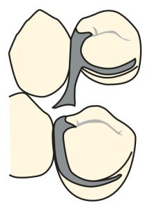 Figure 3-14. Buccal and lingual views of a reverse Akers clasp originating from the mesio-occlusal surface of the abutment tooth and extending into the distobuccal undercut area.