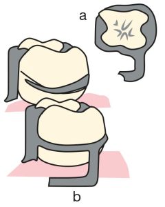 Figure 3-15.a) The ring clasp covers almost the entire tooth surface starting from its point of origin. b) The clasp originates from the mesiolingual surface and terminates at the mesio-buccal undercut, with an additional minor connector supporting the clasp.