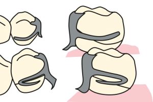 Figure 3-17.The hairpin clasp is used when the undercut is located below the point of origin of the clasp.