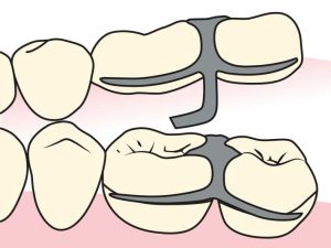 Figure 3-18.The embrasure clasp is used in areas where no edentulous space is present.