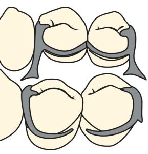 Figure 3-19. The multiple arm clasp consists of two simple circumferential clasps whose reciprocal arms are joined at their terminal ends (Figure 3-19).