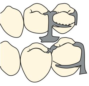 Figure 3-20.The half-and-half clasp is a clasp that has two circumferential retentive arms rising from opposite sides of the abutment tooth. The dashed line in the upper figure indicates the position of the stabilizing arm that should be present in the circumferential clasp.