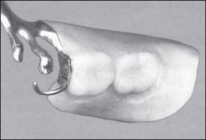 Figure 3-21. RPA clasp