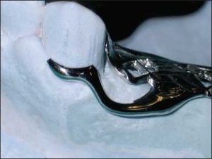 Figure 3-26. Gingival clasp with a horizontal approach arm