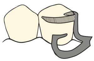 Figure 3-28. Bar and circumferential combination clasp
