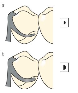 Figure 3-5. The flexibility of a clasp is inversely proportional to its diameter. A clasp with a smaller diameter (a) is more flexible than one with a larger diameter (b).