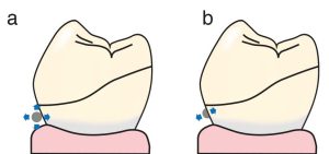 Figure 3-6. A clasp with a round cross-section (a) is more flexible than one with a half-round cross-section (b).