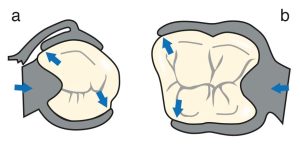 Figure 3-8. The clasp must engage more than 180° of the abutment tooth. This encirclement is continuous in the circumferential clasp (b), whereas it is interrupted in the bar clasp (a). Even if contact between the clasp and the tooth is not continuous, a three-point contact should be established through the occlusal rest, the retentive tip, and the reciprocal component.