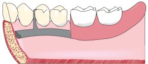 Figure 5-11. The cross-section of the lingual bar is half-pear shaped, with the thicker portion forming the lower edge.
