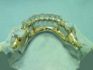 Figure 5-14. The cingulum bar runs along the lingual surfaces of the mandibular anterior teeth in addition to the lingual bar, and is supported by auxiliary occlusal rests located mesial to the premolars.