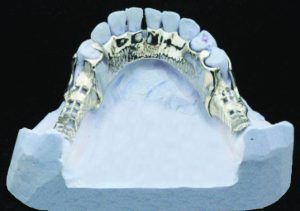Figure 5-15. The linguoplate extends up to the middle third of the lingual surfaces of the mandibular anterior teeth.
