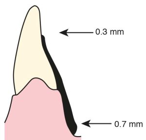 Figure 5-16. The thickness of the upper and lower edges of the lingual plate are different from each other.