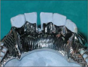 Figure 5-17. When diastema is present in the lower anterior teeth, an interrupted lingual plate can be used to prevent the metal from being visible from the labial surface.