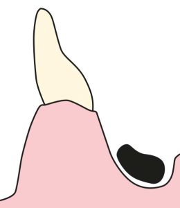 Figure 5-18. Sublingual bar placed over the round-shaped lingual sulcus.