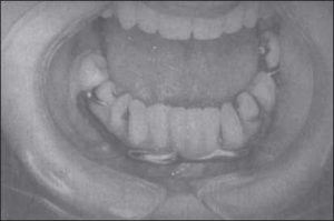 Figure 5-19. The labial bar can reach the buccal region of the posterior teeth and is situated on the labial mucosa of the lower anterior teeth.