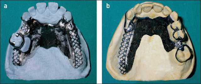 Figure 5-2. In cases such as Class I Mod 1 (a) and Class II Mod 1 (b), the palatal strap may be made wider when increased hard palate support is necessary.