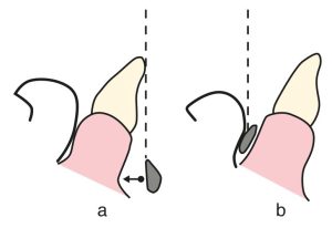 Figure 5-20. In the presence of lingually inclined lower anterior teeth; a) The distance between the lingual bar and the mucosa should be increased. b) It would be more accurate to use the labial bar.