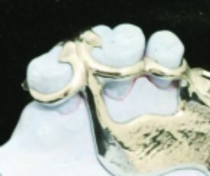 Figure 5-22. Cross-section of a minor connector placed in the interproximal embrasure shows a triangular shape with its apex located in the interdental area.