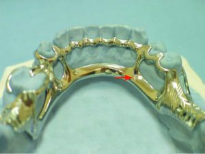 Figure 5-23. The junction between the minor connector and the major connector, which connects auxiliary occlusal rests, should form a rounded right angle.