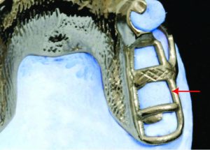 Figure 5-25. The number of lattice-type minor connectors joining the denture base to the major connector is determined such that one is placed between each pair of artificial teeth.