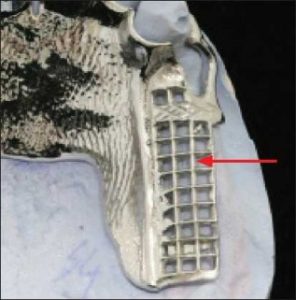 Figure 5-26. The mesh-type minor connector joining the denture base to the major connector has a finer structure.
