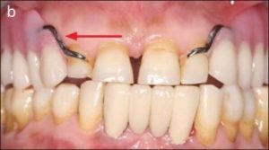 Figure 5-29. b) The minor connector must be left outside the denture base border to maintain its flexibility.
