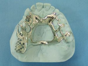 Figure 5-4. A double palatal strap, with the anterior strap designed to be wide and flat and the posterior bar narrow and thin, can be used in modification Class II cases.