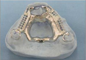 Figure 5-5. A double palatal srap can also be used in modification Class III cases with long edentulous ridges.