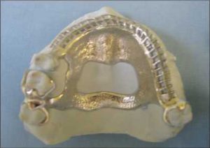 Figure 5-6. In Class IV cases, the anterior portion of the double palatal bar is extended to the anterior edentulous ridge. The lateral portions of the major connector should be positioned at least 6 mm away from the gingival margins of the teeth.