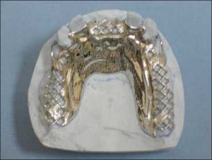 Figure 4-8. Covering the rugae area with the main binder acts as an indirect retainer.