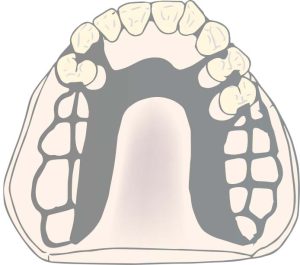 Figure 5-8. In distal extension cases, the use of the U-shaped plate is not recommended without extending to the anterior teeth, as the reduction in rigidity at the midline area prevents adequate force distribution.