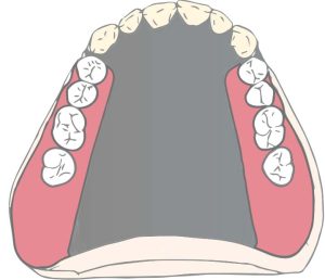 Figure 5-9. The posterior part of the full palatal plate is located at the junction of the soft and hard palate, while the anterior part is supported by singulum rests.