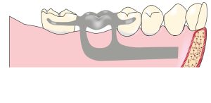 Figure 6-11. Restoring narrowed tooth gaps with occlusal surfaces cast as part of the metal framework can provide more hygienic results.