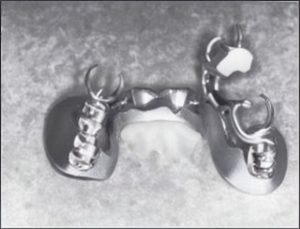 Figure 6-2. A denture base made entirely of metal is not suitable for relining and rebasing procedures and also has the disadvantage of being relatively heavy.