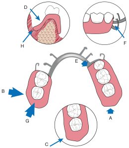 Figure 6-3. The mandibular base should cover the retromolar pad (A) and extend buccally to encompass the buccal plane region (B). The distolingual border should descend directly toward the mylohyoid area; the distolingual flanges should be tapered laterally and the distal edge should be finished with a bevel (C). The lingual flange should be tapered to leave adequate space for the tongue; the labial flange should have a slight concavity to accommodate the buccinator muscle (D). The metal finishing areas on the inner and outer surfaces of the prosthesis (E) should be sharp and fine. The anterior border of the buccal flange should taper and bevel as it extends backward (F). The relationship between the acrylic resin and the teeth should be smooth and well-defined (G). All edges of the base should be refined, polished well, and the buccal edge should be at least 2 mm thick (H).