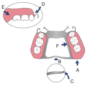 Figure 6-4. The maxillary denture base should cover the tuberosity region and hamular notch (A). The posterior palatal border is finished on resilient but non-moving tissues. This border is positioned close to a line passing through the hamular notch or fovea palatina areas on both sides (B). If the tissue surface of the base is made of acrylic resin, a post-dam should be created; if made of metal, the surface should be roughened. The posterior border is slightly tapered and beveled (C). The anterior border of the buccal flange should also taper as it extends posteriorly and be beveled (D). The buccal flange is slightly concave to provide space for the buccinator muscle (E). The metal finishing lines should be smooth (F). The buccal flanges should have a thickness of at least 2 mm and be polished smoothly.