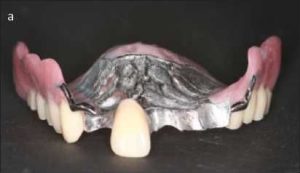 Figure 6-6a. Facing for maxillary denture