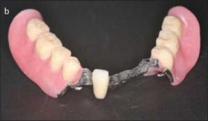 Figure 6-6a. Facing for maxillary denture
